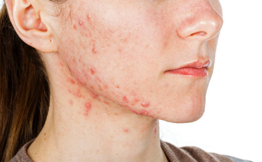 Beyond Breakouts: How a Niacinamide Serum Can Be Your Acne Ally